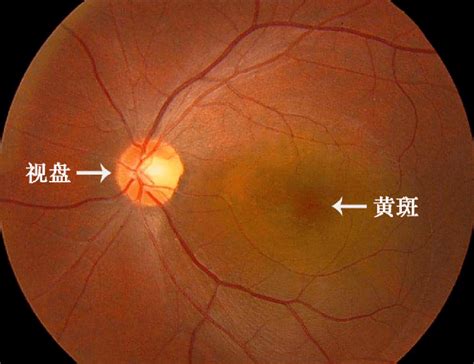 眼睛有斑|视网膜黄斑